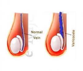 روش درمان بیماری واریکوسل